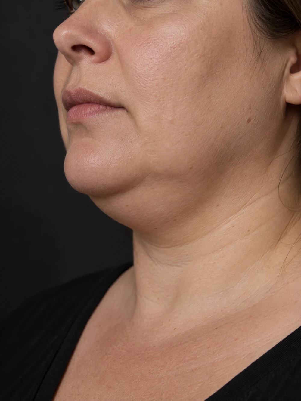 Seitenansicht eines natürlich volleren Unterkinns und des oberen Halsbereichs