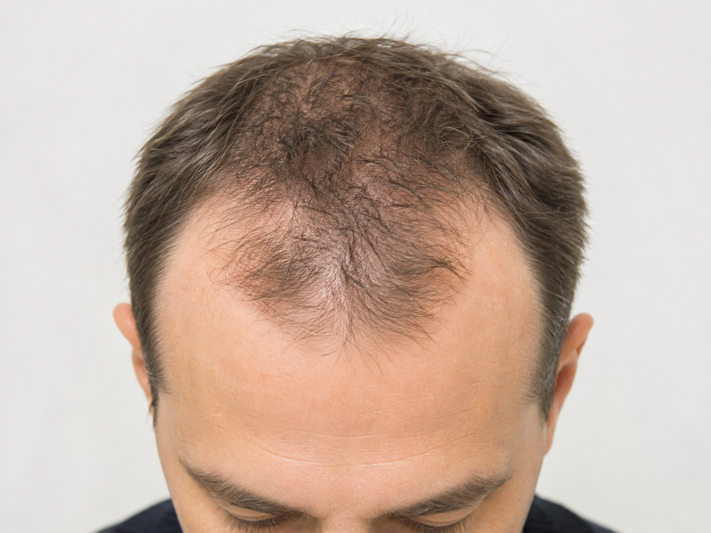 Nahaufnahme einer männlichen Kopfhaut mit zurückweichender Haarlinie und ausgedünntem Oberkopf